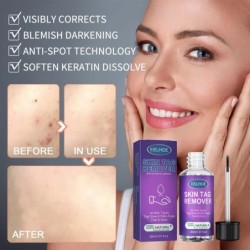Skin tag / warts remover - dark spots / freckles - liquid - 30 mlSkin